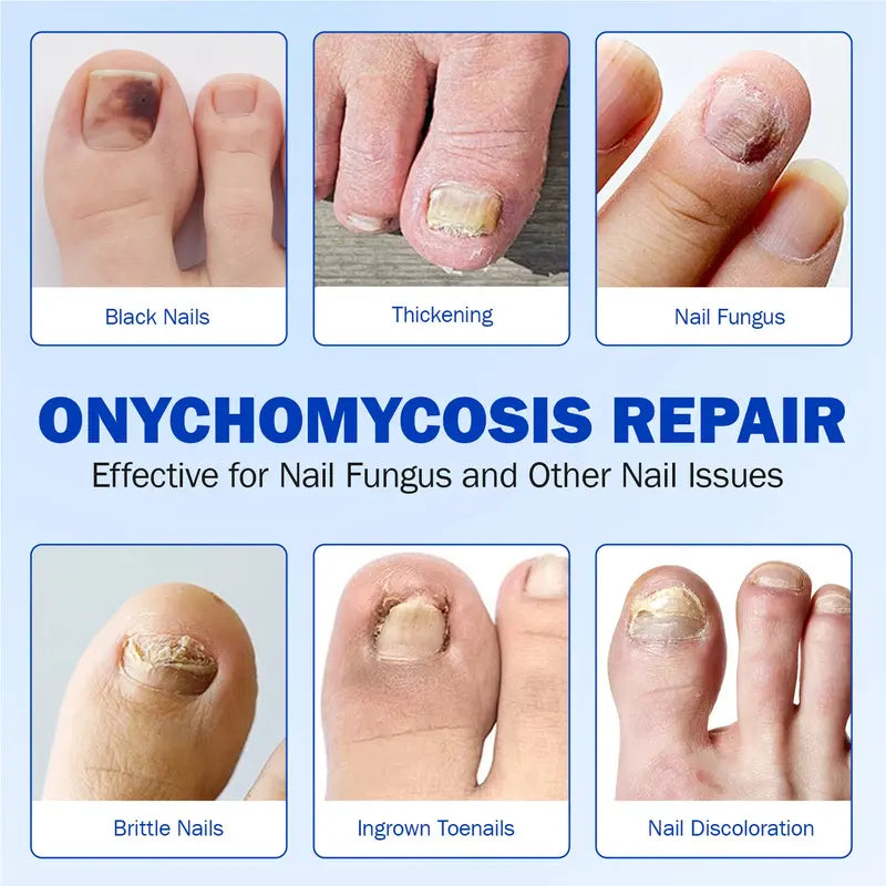 Intensive Nail Treatment Patches——Eliminate Fungus, Strengthen Nails, Restore Beauty Instantly!