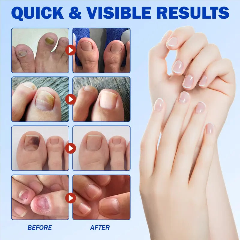 Intensive Nail Treatment Patches——Eliminate Fungus, Strengthen Nails, Restore Beauty Instantly!