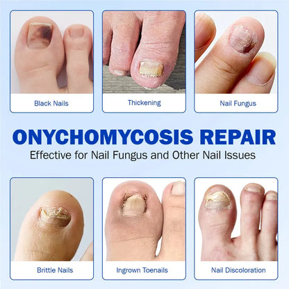 Intensive Nail Treatment Patches——Eliminate Fungus, Strengthen Nails, Restore Beauty Instantly!