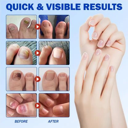 Intensive Nail Treatment Patches——Eliminate Fungus, Strengthen Nails, Restore Beauty Instantly!